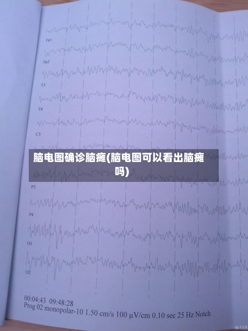 脑电图确诊脑瘫(脑电图可以看出脑瘫吗)-第2张图片