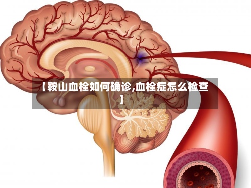 【鞍山血栓如何确诊,血栓症怎么检查】
