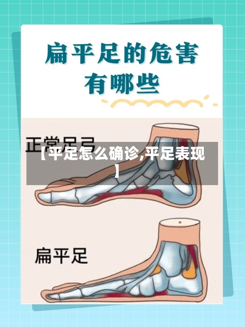 【平足怎么确诊,平足表现】-第2张图片