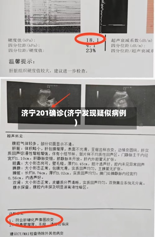 济宁201确诊(济宁发现疑似病例)